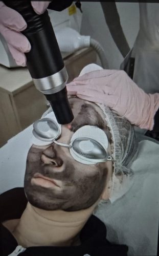 Laserowy peeling węglowy